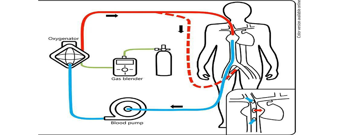 ecmo的工作原理图片